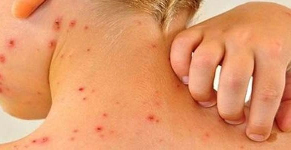 СЭРЭМЖЛҮҮЛЭГ: Менингококкт халдварын эрсдэл өндөр улирал эхэлж байна